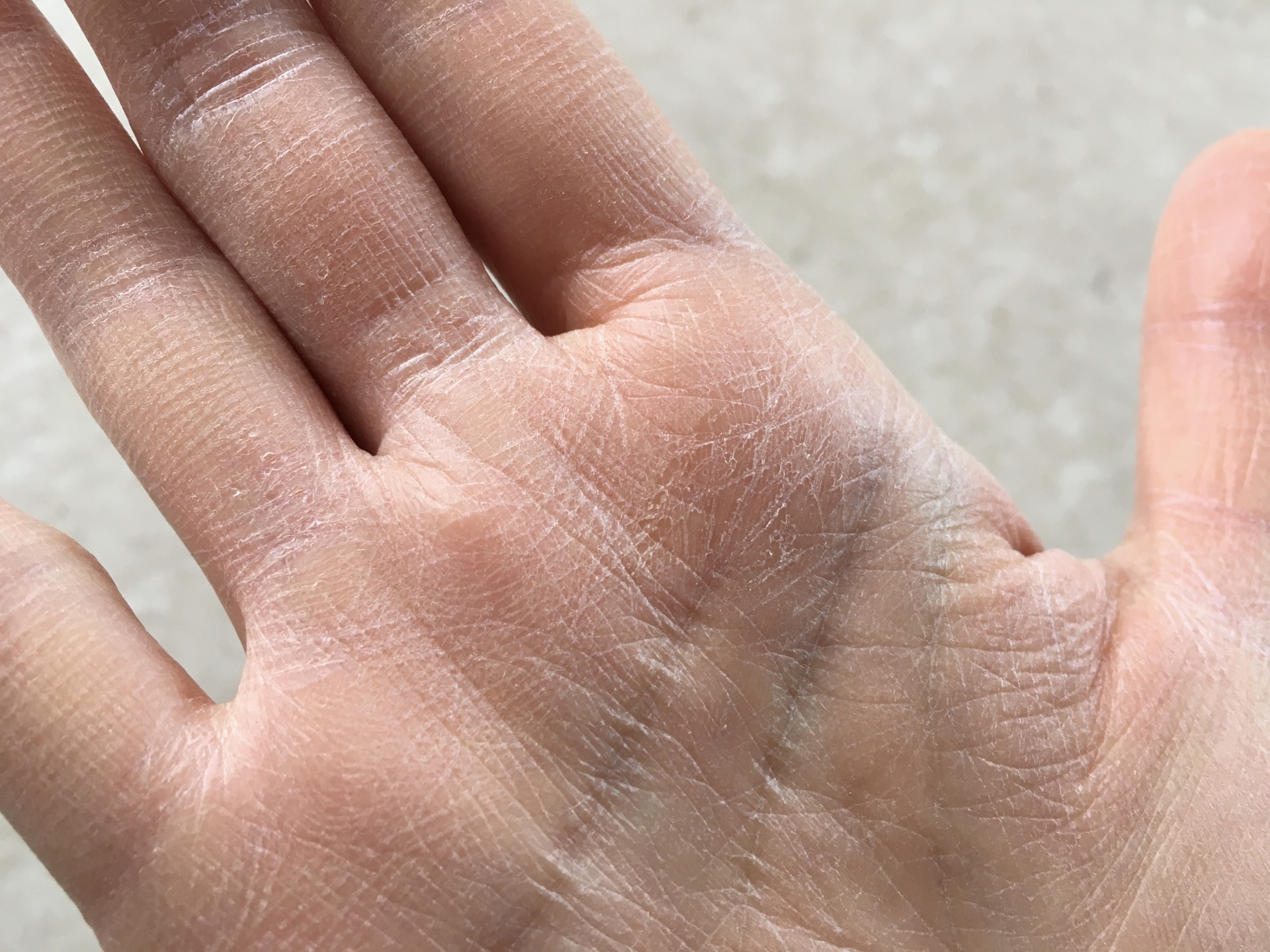  1.新生児の皮むき